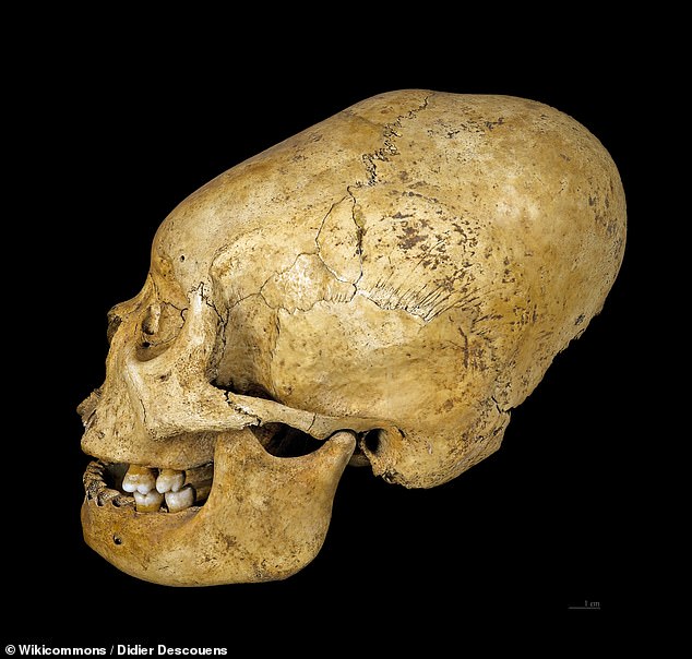 Above, one example of a deliberate deformity of the skull from a Proto-Nazca culture in Peru, dated to between 200 and 100 BC - and now stored by the Muséum de Toulouse in France